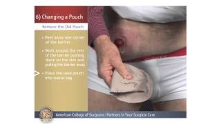 ColostomyIleostomy Changing a Pouch [upl. by Einaeg]