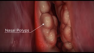 Nasal Polyps diagnosis and treatment options [upl. by Aznecniv]