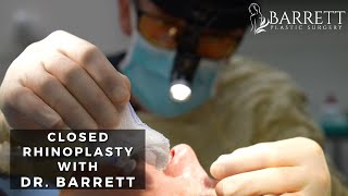 Closed Rhinoplasty  Barrett Plastic Surgery [upl. by Leasia]