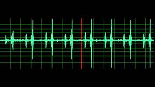 Pulmonary Associated Heart Sounds PAH Split S2 [upl. by Blandina]