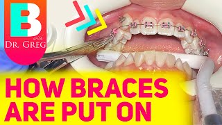 Getting Braces 101  Putting Braces On [upl. by Harrat]