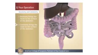 ColostomyIleostomy Your Operation [upl. by Eelatsyrc]