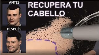 IMPLANTE o INJERTO de CABELLO 💕🙆 para MUJERES Y HOMBRES  Todas las RESPUESTAS  DR ALBERTO CALVO [upl. by Nil330]