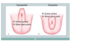 Hypospadias and Epispadias [upl. by Ennyleuqcaj]