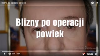 Blizny po operacji powiek [upl. by Nelyag]