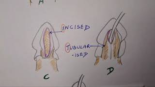 Hypospadias  TIP [upl. by Llebana]