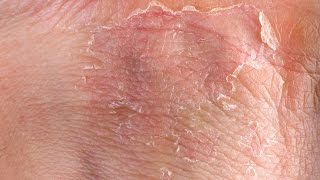 How I Healed Eczema Naturally  My Story [upl. by Nodyarg924]