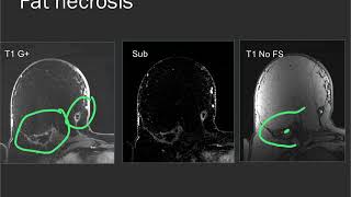 Screening Mammogram vs Ultrasound [upl. by Kilam881]