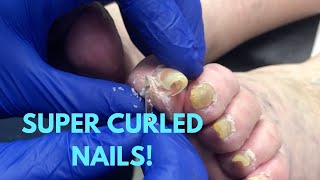 SUPER CURLED NAIL CARE [upl. by Akira]