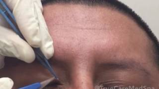 SKIN TAG REMOVAL  EYE LID [upl. by Ermey]