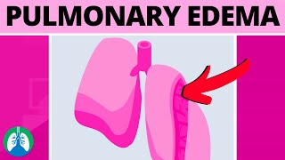 Pulmonary Edema Medical Definition  Quick Explainer Video [upl. by Ahern]