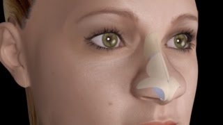 Bulbous Large Nasal Tip Nose Job Rhinoplasty [upl. by Suirtemid573]