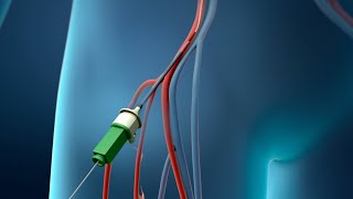 Angioplasty Procedure Animation Video [upl. by Spalding]