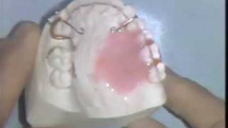 Orthodontic Acrylic Technique [upl. by Janna]