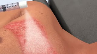 HOW TO TREAT A BURN — ER Doctor Explains Treating Burns Blisters Classifications amp Degrees [upl. by Sanders489]