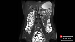 UltrasoundGuided Peripheral IV Insertion  BAVLS [upl. by Melburn]