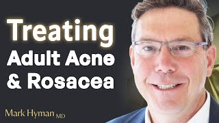 Treating Adult Acne amp Rosacea From The Inside Out [upl. by Torres345]