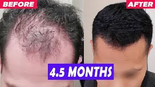 MOST INSANE Finasteride Hair Regrowth You Will See 4 Month Result [upl. by Ellezaj148]