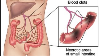 Mesenteric Ischemia [upl. by Aibara]