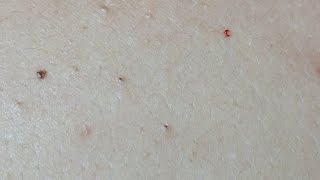 Acne Treatment on the Back Uninfected Lesions [upl. by Tnarg]