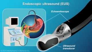 Understanding EUSFNA [upl. by Stock729]