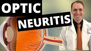 Optic Neuritis Symptoms Diagnosis and Treatment [upl. by Jankey]