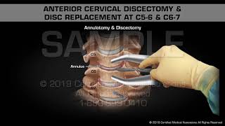 Anterior Cervical Discectomy amp Disc Replacement at C56 amp C67  Medical Animation [upl. by Nahrut]