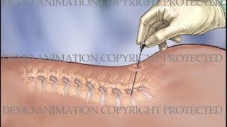 Lumbar IDET Intradiscal Electrothermal Therapy Procedure [upl. by Aralc]