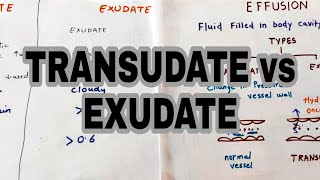 Transudate vs Exudate  Types of effusion  lights criteria [upl. by Akienat324]