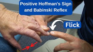 Positive Hoffmans Sign and Babinski Reflex in an MS Patient [upl. by Siuqramed146]