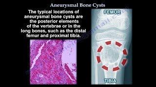 Aneurysmal Bone Cyst  Everything You Need To Know  Dr Nabil Ebraheim [upl. by Ietta]