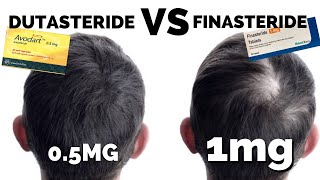 Dutasteride Mega Guide  Better Than Finasteride [upl. by Bogusz]