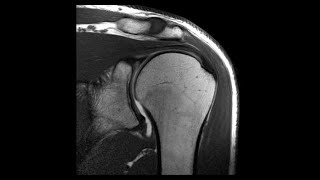 PROTOCOLO RESONANCIA MAGNETICA DE HOMBRO [upl. by Jillana258]