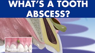 TOOTH ABSCESS dental infection  PHLEGMON symptoms and treatment © [upl. by Ytsud]