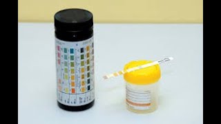 Dipstick Urinalysis Analysis [upl. by Morgana]