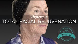 69 yo Female Total Facial Rejuvenation  An Amazing Transformation  Aesthetic Minutes Facelift [upl. by Inafetse513]