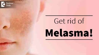 Melasma or pigmentation of skin Treatment available  Dr Deepak P Devakar [upl. by Curhan]