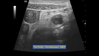 Mesenteric Vascular Occlusion  Ultrasound Case  GIT [upl. by Nannahs]