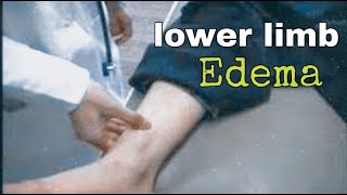 lower limb edema examination [upl. by Syxela]