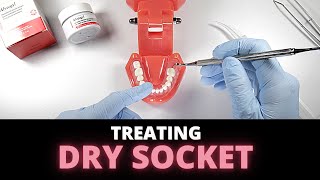 Tips For Managing Dry Socket Alveolar Osteitis  OnlineExodontiacom [upl. by Sitruk]