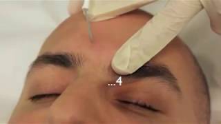 Sebaceous Hyperplasia Treatment using Electrodessication [upl. by Pussej]