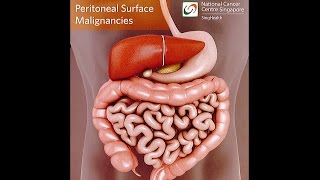 All About Peritoneal Tumours Causes Symptoms Diagnosis and Treatment [upl. by Snahc]