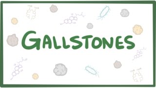 Gallstones cholelithiasis [upl. by Nawyt52]