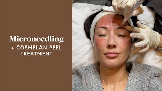 Microneedling Treatment amp Cosmelan Peel For My Melasma  Susan Yara [upl. by Siradal248]