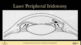 Iridotomy amp iridoplasty [upl. by Eelarual896]