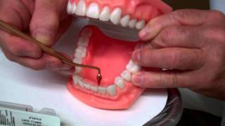 Rubber Tip Stimulator  Oral Hygiene Instructions by Dr Berdy periodontist Jacksonville FL [upl. by Calmas]