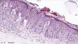 Compound Melanocytic Nevus  Histopathology [upl. by Twitt347]