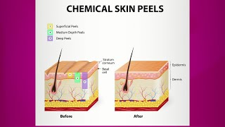 Chemical Peel Purpose amp Types [upl. by Nnoryt]