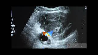 Thrombin injection to occlude a femoral pseudoaneurysm [upl. by Aerdnu156]