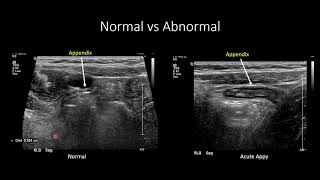 US for Suspected Appendicitis in Children [upl. by Antone]